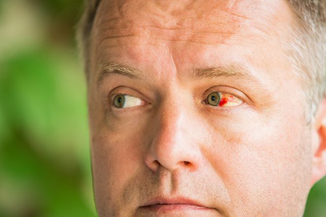 2026世界杯熬夜看球伤眼？警惕这些不可逆的眼病
