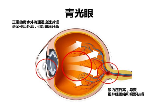 2026世界杯熬夜看球伤眼？警惕这些不可逆的眼病